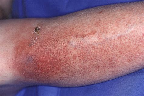 This is the American ICD-10-CM version of K04. . Cellulitis icd 10